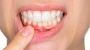 چند راهکار ساده طب سنتی برای درمان "خونریزی لثه و استحکام دندان‌ها"
